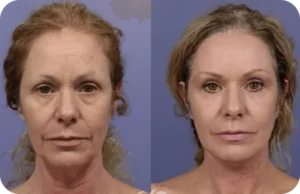 Synevra UltraLift Benefits